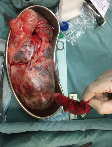 Nữ bệnh nhân mang khối u chứa 7 lít dịch 