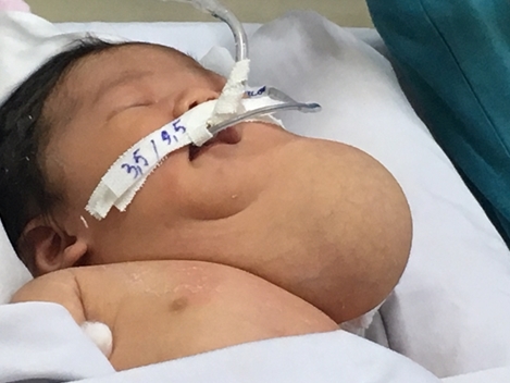 Ca mổ "bắt thai" phối hợp giữa các bác sĩ Sản-Nhi