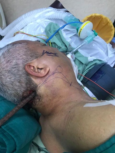 Ngã tường rào, người đàn ông bị thanh sắt đâm xuyên cổ