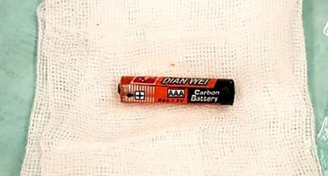 Bé 4 tuổi mải chơi nuốt viên pin vào bụng