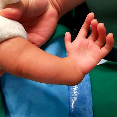 Phẫu thuật thành công bàn tay chữ L cho bé trai 2 tuổi 