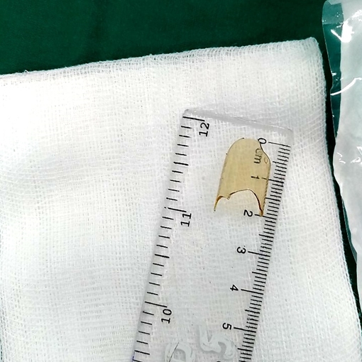 Bé gái 8 tháng tuổi nuốt ống thuốc thuỷ tinh vỡ mắc trong họng