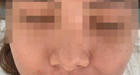 Đắp mặt nạ Đông y trắng da khiến mặt sưng phù nổi mụn