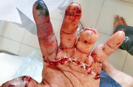 Nối bàn tay cho nam công nhân bị đứt lìa do tai nạn lao động