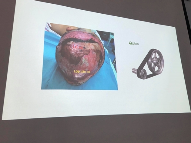 Tái tạo da đầu cho bé gái bị cuốn tóc vào máy xay nước đá