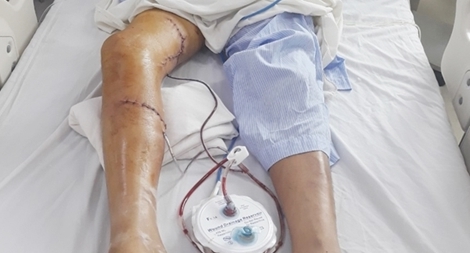 Hỗ trợ khẩn cấp cứu bàn chân bị tai nạn máy cưa 