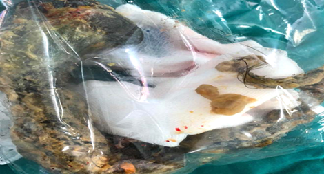 Bé gái tắc ruột vì “ăn tóc”