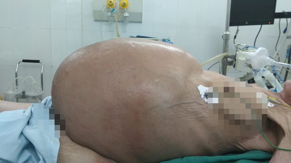 Mổ lấy khối u buồng trứng gần 30kg trong bụng cụ bà 78 tuổi