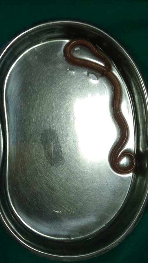 Gắp con giun dài 15cm trong dạ dày nữ bệnh nhân 65 tuổi