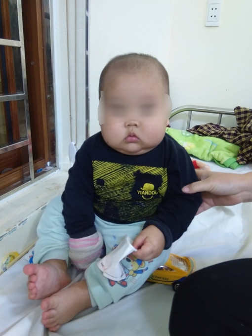 Tự điều trị bằng thuốc chứa corticid, bé trai 17 tháng tuổi bị suy thượng thận