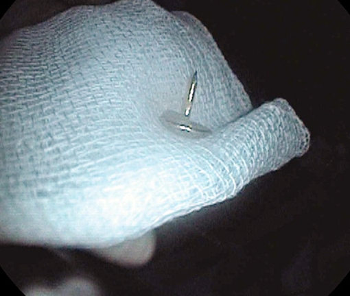 Bé trai 11 tháng tuổi nuốt đinh vít vào bụng