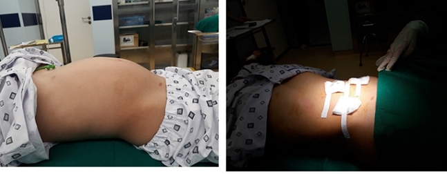 Bé gái 10 tuổi mang khối nang buồng trứng khổng lồ