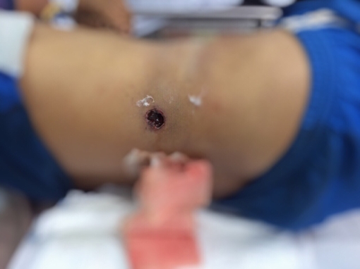 Súng săn tự cướp cò, bị vết thương thấu bụng 