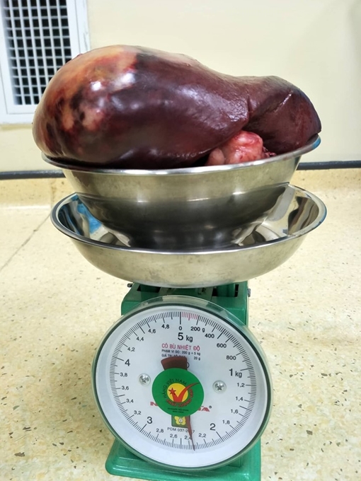 Phẫu thuật lấy khối u lách khổng lồ cho bệnh nhân 24 tuổi. 