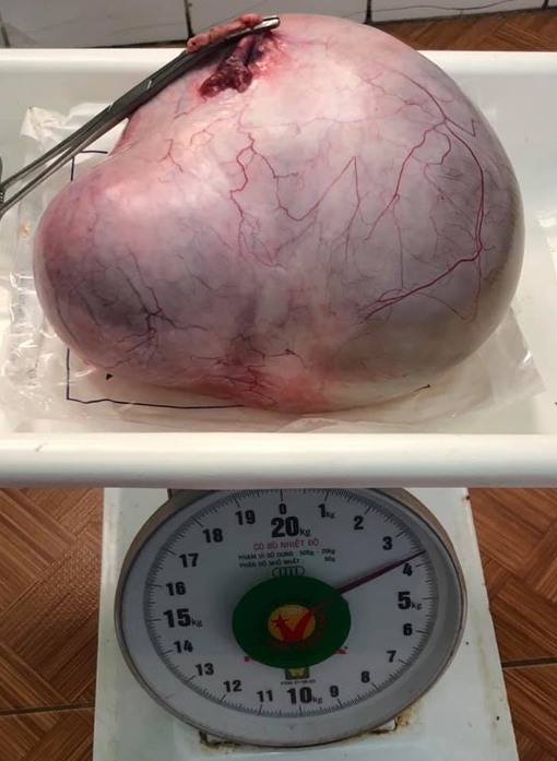 Người phụ nữ 67 tuổi mang khối u buồng trứng nặng 3,7kg 