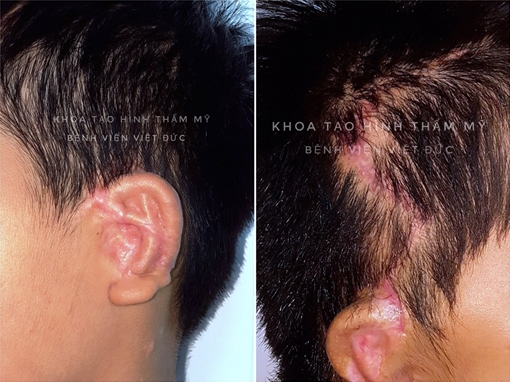 BV Việt Đức phẫu thuật tạo hình thành công tai nhỏ microtia tiên tiến nhất thế giới
