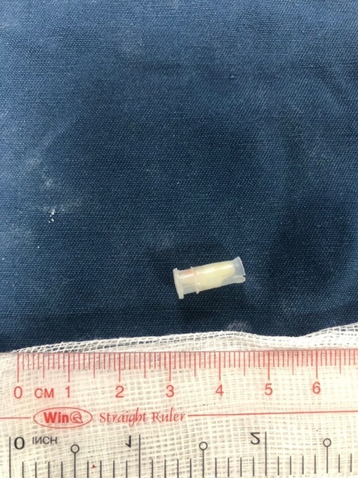 Bé trai 3 tuổi nuốt còi đồ chơi vào phế quản