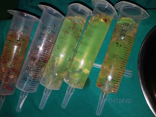 Vỡ túi nâng ngực sau khi phẫu thuật thẩm mỹ 