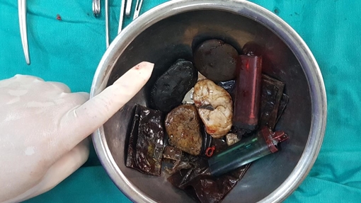 Hy hữu: Người đàn ông ăn được “tất cả mọi thứ”