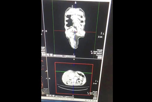 Mổ cấp cứu cụ ông U90 phình động mạch chủ bụng