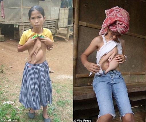 Kỳ lạ bé gái có “chị em sinh đôi” ngay trước ngực