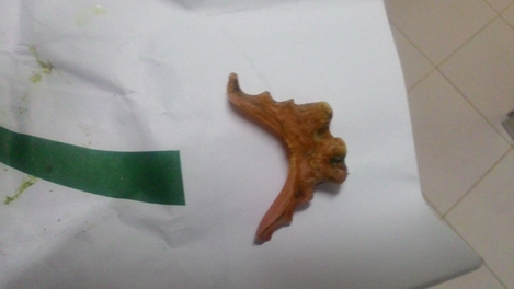 Một phụ nữ bị thủng ruột vì nuốt hàm răng giả