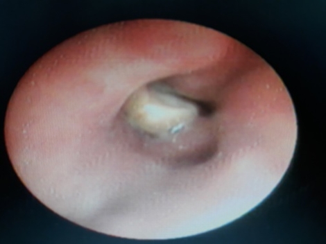 Cụ bà U90 suýt chết vì bị hóc hạt sen