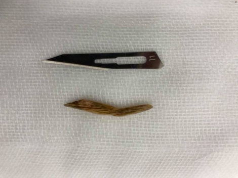 Xương cá đâm thủng hậu môn