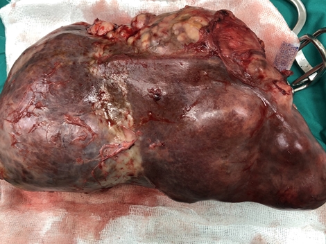 Khối u nặng 3 kg trong bụng người đàn ông