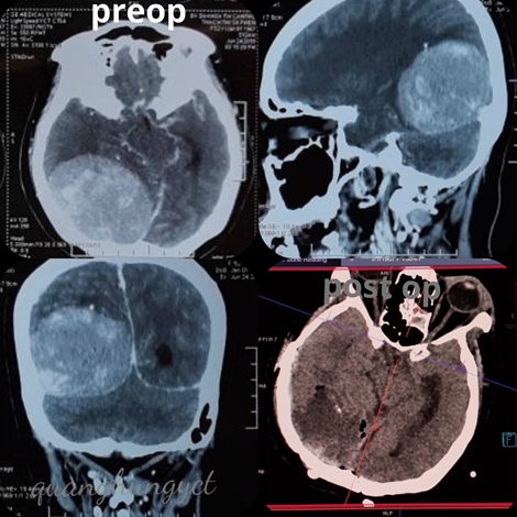 Cứu sống bệnh nhân bị u màng não "khủng"