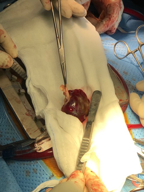 Cứu sống bệnh nhân bị u nhầy nhĩ hiếm gặp 