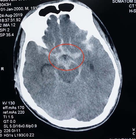 Cứu sống bệnh nhân chấn thương sọ não, vỡ túi phình mạch máu não
