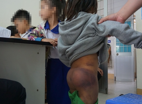Không khởi tố vụ 4 trẻ bị người thân đánh