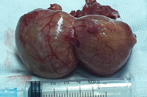 Bệnh nhân bị u màng tim “khủng” được cứu sống