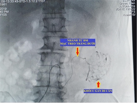 Lần đầu tiên can thiệp ung thư gan di căn bằng nút động mạch hóa chất 