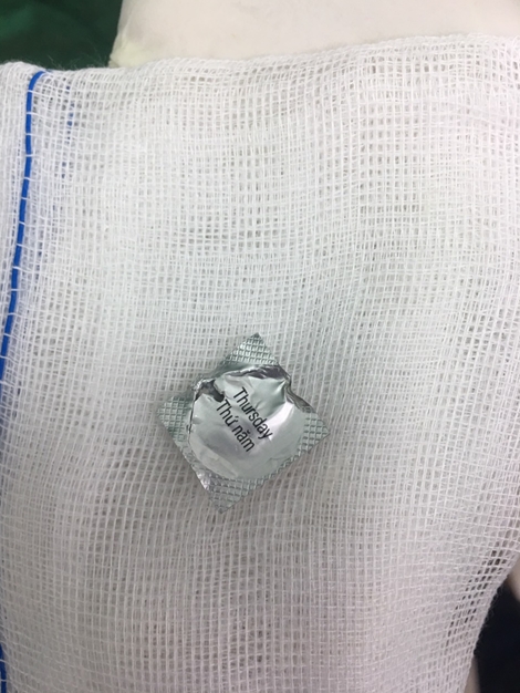 Gắp viên thuốc nguyên vỏ ra khỏi thực quản bệnh nhân sáng 30 Tết 