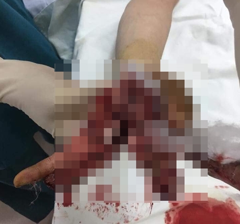 Nát bàn tay do điện thoại nổ trong lúc vừa sạc vừa sử dụng