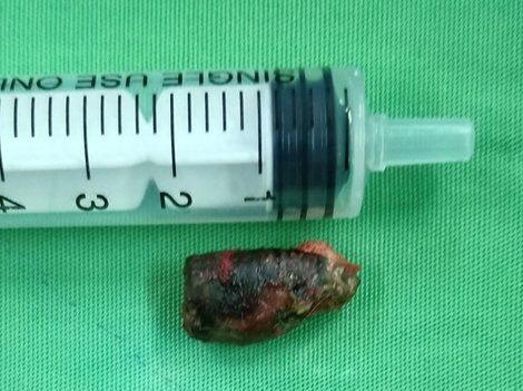 Lấy đầu đạn nằm 51 năm trong cơ thể một cựu chiến binh 