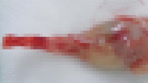 Thai nhi mắc hội chứng người cá vô cùng hiếm gặp