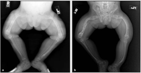 Bé sơ sinh có triệu chứng bệnh xương thủy tinh 