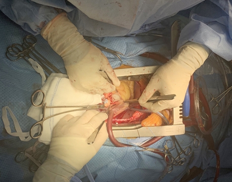 Cứu sống bệnh nhân tái hẹp van tim nhân tạo cực nặng 