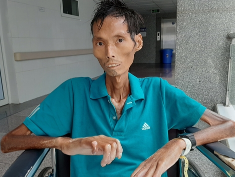 Gia cảnh khốn khó của người đàn ông ngày càng khô quắt