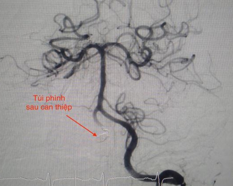 Cứu sống bệnh nhân ngưng tim, ngưng thở 2 lần ngoài viện