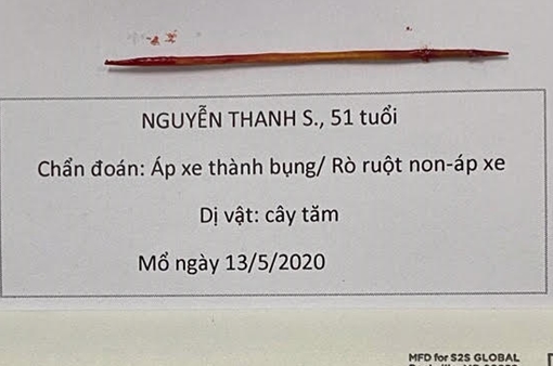 Có phải cầu răng dài giúp khắc phục vấn đề răng dài?
