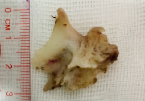 Người đàn ông bị xương cá tra khủng cắm vào thực quản