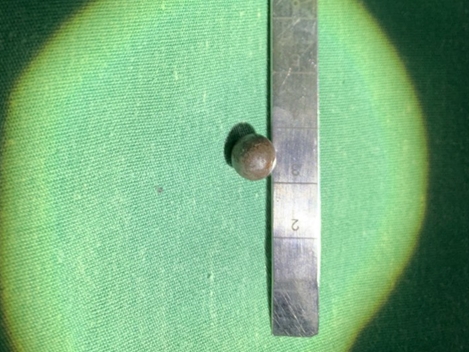 Cứu sống bệnh nhân bị đạn bi găm vào cột sống cổ 