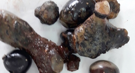 Sốc với "đống  sỏi" trong thận người đàn ông 