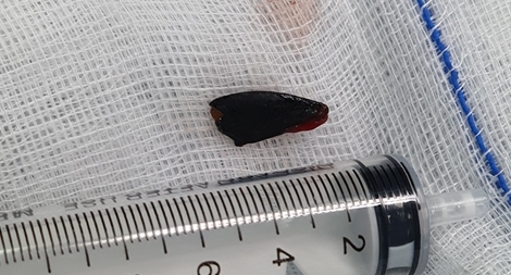 Hạt hồng xiêm nằm trong phế quản người phụ nữ 27 năm 