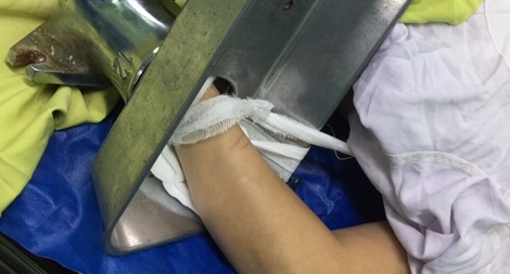 Người phụ nữ nhập viện với bàn tay trái trong máy xay thịt