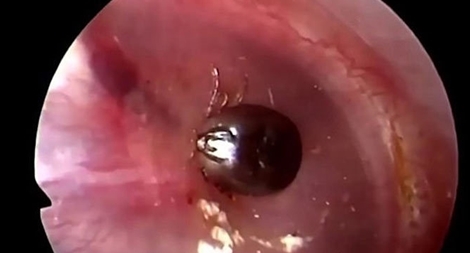 Bé gái 10 tuổi bị ve chó chui vào tai 